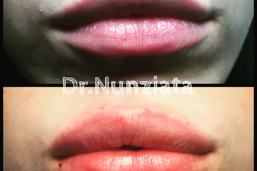 Filler labbra prima e dopo - 773794