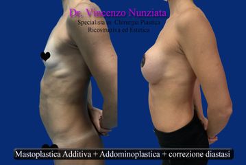 correzione diastasi + mastoplastica