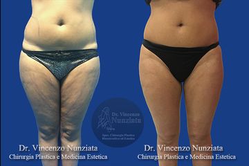 Liposcultura - Dr. Vincenzo Nunziata