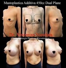 Mastoplastica additiva - Dr. Vincenzo Nunziata