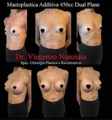 Mastoplastica additiva - Dr. Vincenzo Nunziata