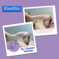 Rinofiller - Dr. Vincenzo Nunziata