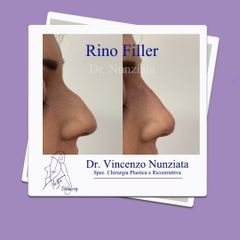 Rinoplastica - Dr. Vincenzo Nunziata