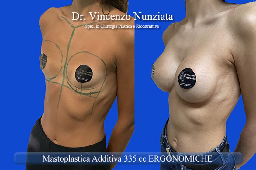 Mastoplastica additiva prima e dopo - 863917