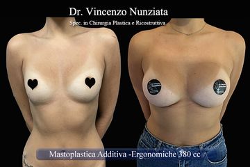 Mastoplastica additiva - Dr. Vincenzo Nunziata