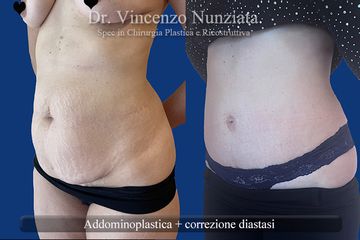 Addominoplastica - Dr. Vincenzo Nunziata
