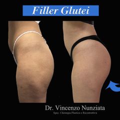 Filler - Dr. Vincenzo Nunziata