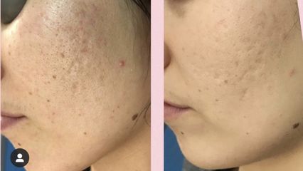 Acne prima e dopo