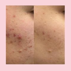 Trattamento Acne mediante peeling- Dott.ssa Maria Trapasso