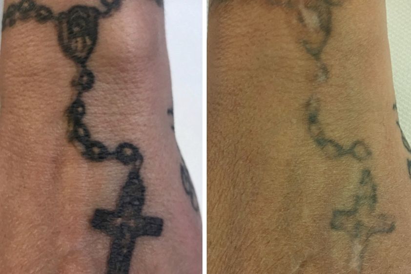 Rimozione tatuaggi prima e dopo - 786007