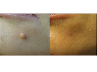 Condilomi prima e dopo - 746165