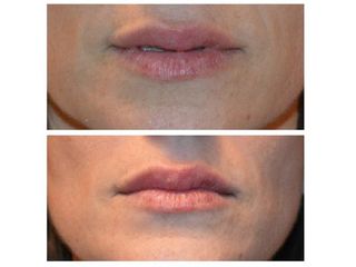 Armonizzazione di labbra superiore ed inferiore - Dr. Luca M. Apollini