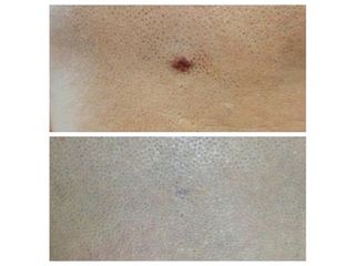 Trattamento laser di verruche - Dr. Luca M. Apollini