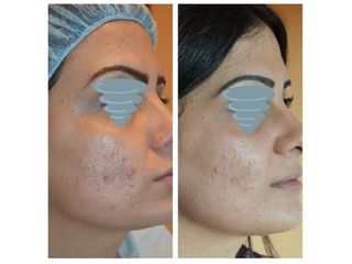 Trattamento delle cicatrici da acne - Dr. Luca M. Apollini