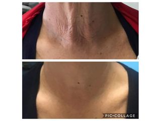 Biostimolazione PRP - Dr. Luca M. Apollini