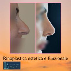 Rinoplastica estetica e funzionale - Dr. Luca M. Apollini