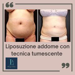 Liposuzione addome con tecnica tumescente - Dr. Luca M. Apollini