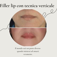 Filler labbra - Dr. Luca M. Apollini