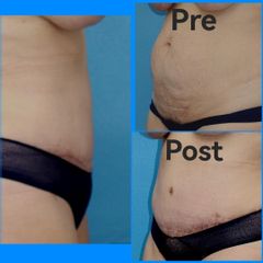 Addominoplastica e liposuzione - Dr. Luca M. Apollini