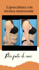 Liposcultura con tecnica tumescente - Dr. Luca M. Apollini