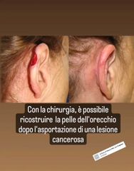 Plastica padiglione auricolare - Dr. Luca M. Apollini