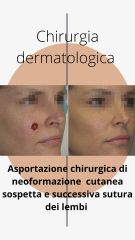 Asportazione chirurgica neoformazioni cutanee - Dr. Luca M. Apollini