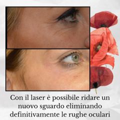 Eliminazione definitiva rughe oculari - Dr. Luca M. Apollini