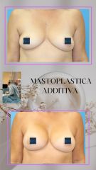 Mastoplastica additiva - Dr. Luca M. Apollini
