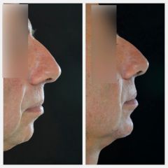 Filler mento - Dr. Luca M. Apollini