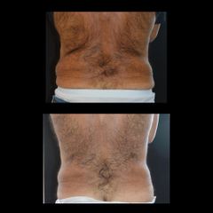 Dr. Luca M. Apollini Liposuzione non chirurgica
