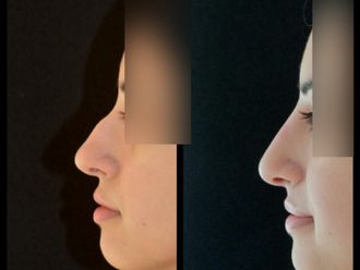 Mentoplastica prima e dopo - 875014