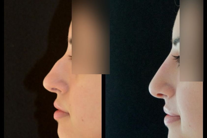 Mentoplastica prima e dopo - 875014