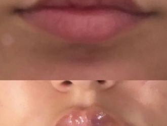 Filler labbra prima e dopo - 877557