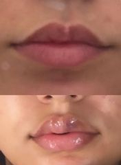 Dr. Luca M. Apollini Filler Labbra