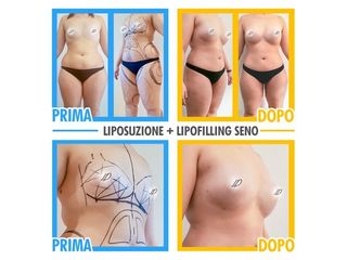 Lipofilling seno prima e dopo