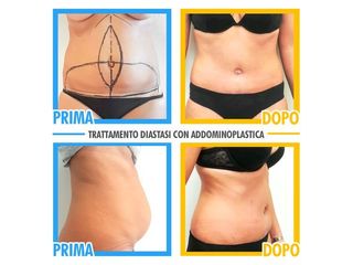 diastasi prima e dopo