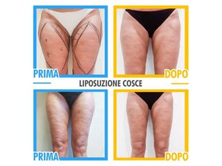 Liposuzione prima e dopo