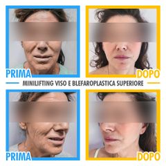 Blefaro superiore prima e dopo