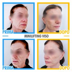minilifting viso prima e dopo
