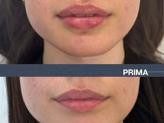 Filler labbra prima e dopo - 874317