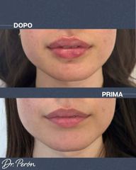 Dr Luciano Perrone Filler Labbra
