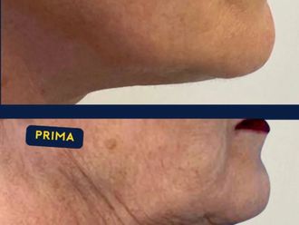 Ringiovanimento prima e dopo - 874318
