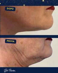 Dr Luciano Perrone Endolift