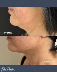 Dr Luciano Perrone Endolift
