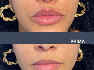 Filler labbra prima e dopo - 874320