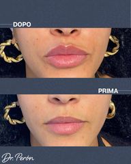 Dr Luciano Perrone Filler Labbra