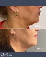 Dr Luciano Perrone Endolift