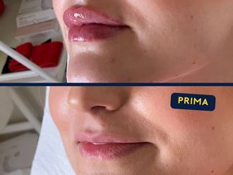 Filler labbra prima e dopo - 874323