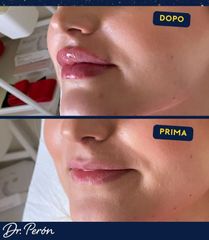 Dr Luciano Perrone Filler Labbra