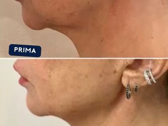 Ringiovanimento prima e dopo - 874704